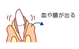 血や膿が出る。